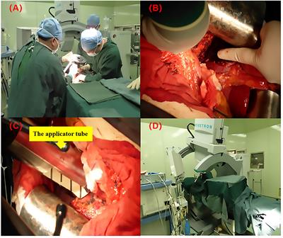 Long-Term Outcome of Centrally Located Hepatocellular Carcinomas Treated by Radical Resection Combined With Intraoperative Electron Radiotherapy (IOERT)